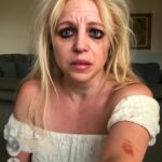 Cantora compartilha imagens com bandagens e hematomas, gerando comoção na comunidade LGBTQIA+