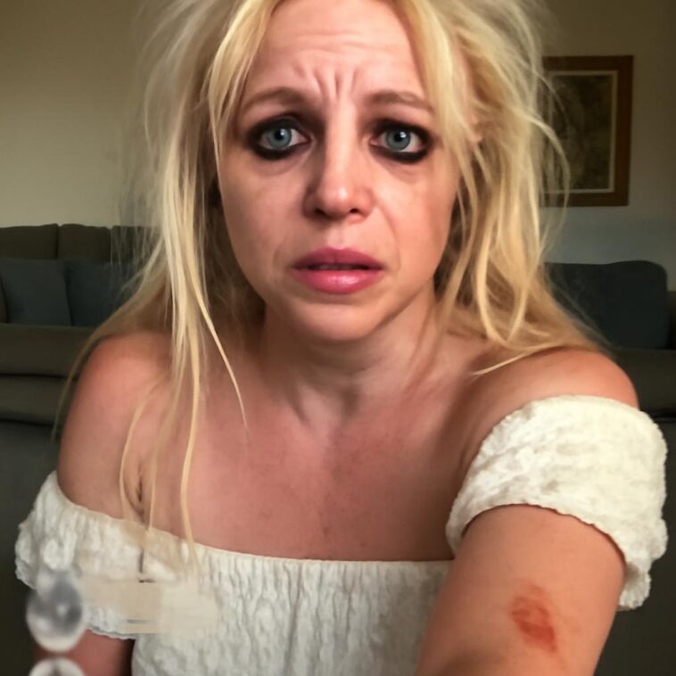 Cantora compartilha imagens com bandagens e hematomas, gerando comoção na comunidade LGBTQIA+